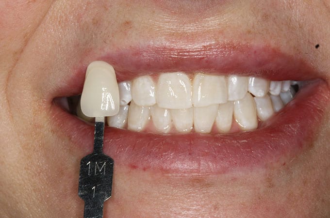 ZOOM Whitening