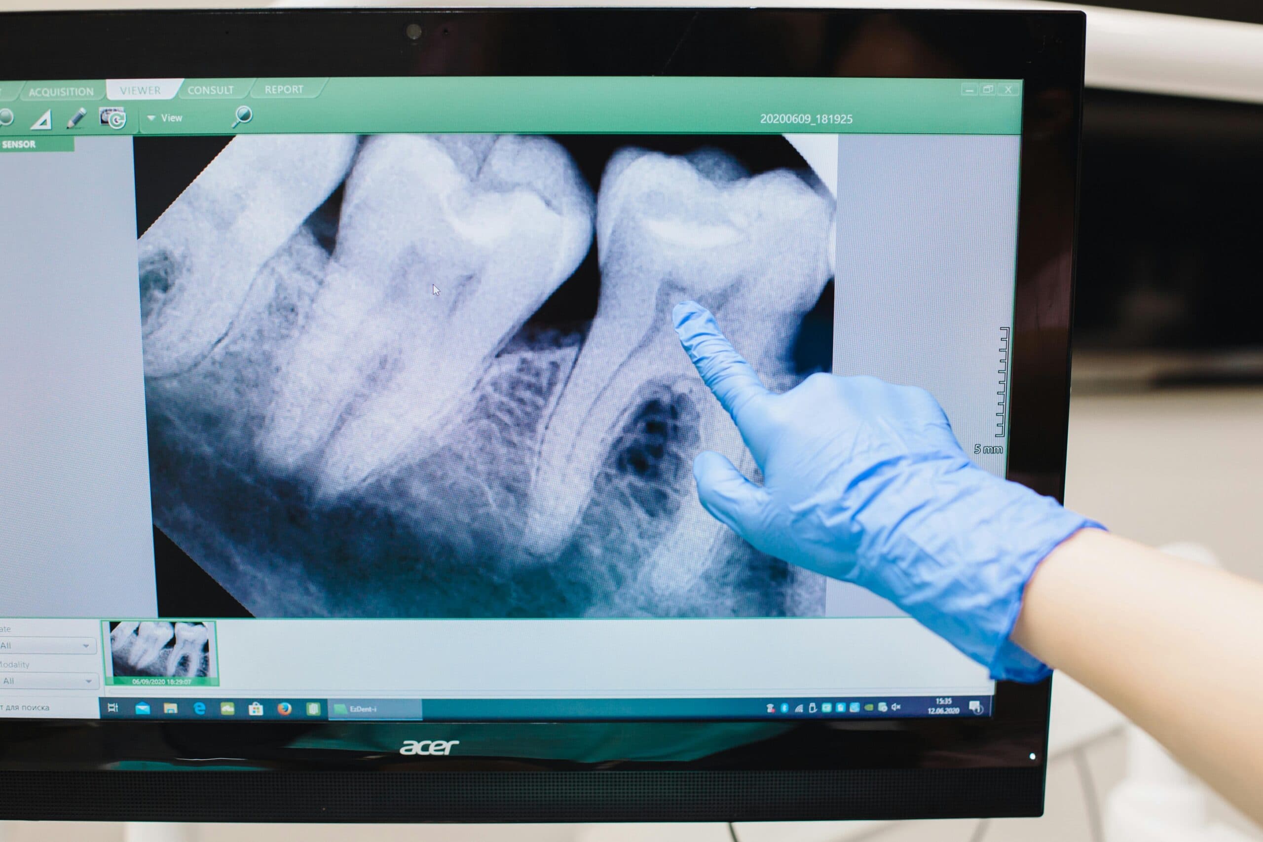 CariVu Caries Detector